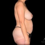 Mommy Makeover Before & After Patient #716