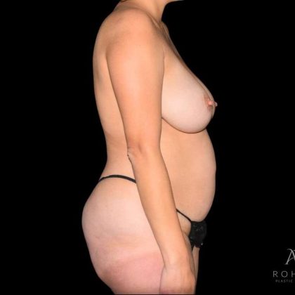 Mommy Makeover Before & After Patient #716