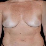 Breast Augmentation Before & After Patient #980