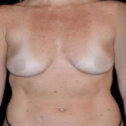 Breast Augmentation Before & After Patient #980