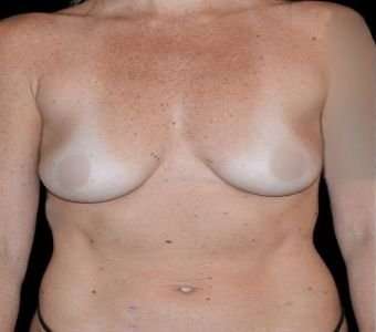 Breast Augmentation Before & After Patient #980