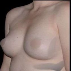 Breast Augmentation Before & After Patient #985