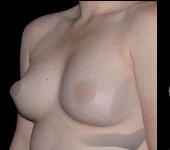 Breast Augmentation Before & After Patient #985