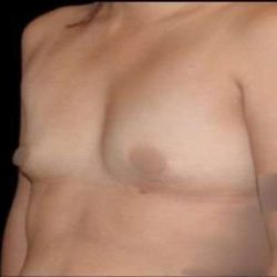 Breast Augmentation Before & After Patient #992