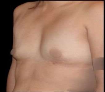 Breast Augmentation Before & After Patient #992