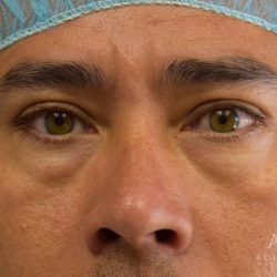 Blepharoplasty Before & After Patient #995