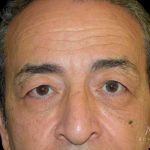 Blepharoplasty Before & After Patient #1000