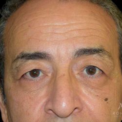 Blepharoplasty Before & After Patient #1000