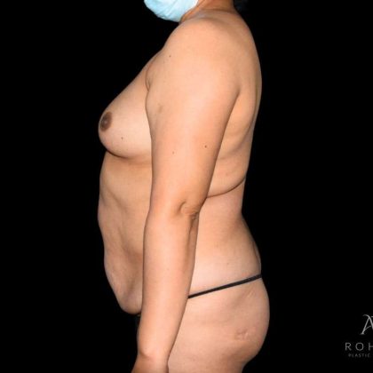 Mommy Makeover Before & After Patient #723