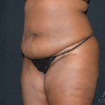Tummy Tuck Before & After Patient #737