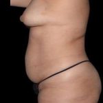 Tummy Tuck Before & After Patient #744