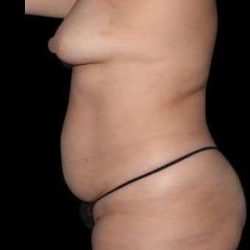 Tummy Tuck Before & After Patient #744