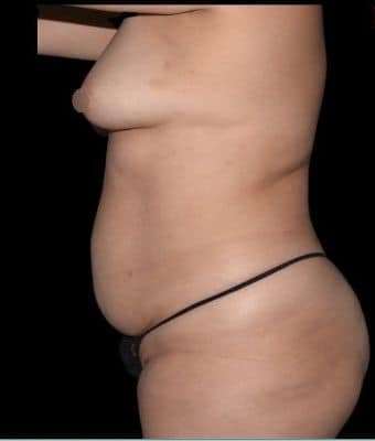 Tummy Tuck Before & After Patient #744