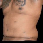 Tummy Tuck Before & After Patient #749