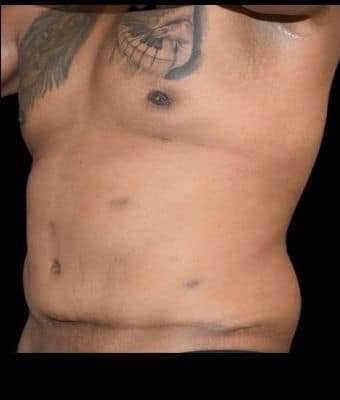 Tummy Tuck Before & After Patient #749