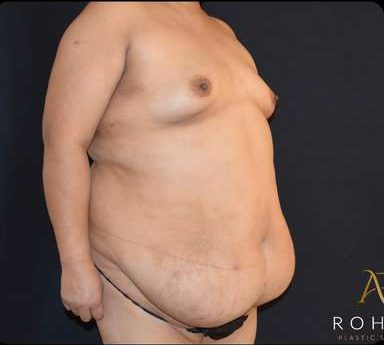 Mommy Makeover Before & After Patient #383