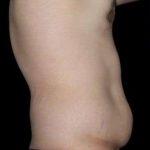 Tummy Tuck Before & After Patient #756