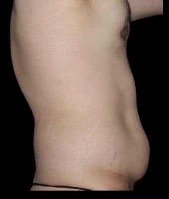 Tummy Tuck Before & After Patient #756
