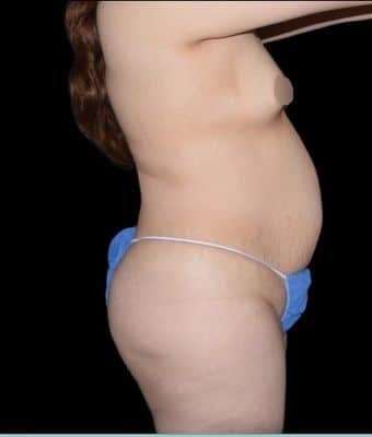 Tummy Tuck Before & After Patient #763