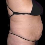 Tummy Tuck Before & After Patient #770