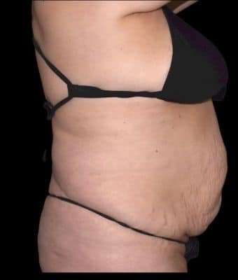 Tummy Tuck Before & After Patient #770