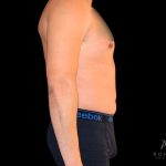 Liposuction Before & After Patient #833