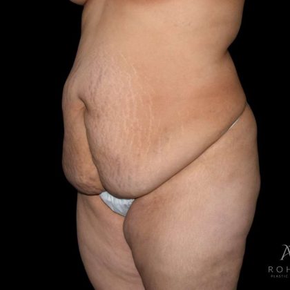 Liposuction Before & After Patient #847