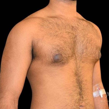 Gynecomastia Before & After Patient #854