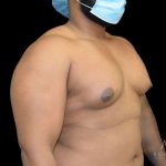 Gynecomastia Before & After Patient #861