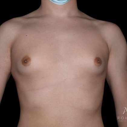 Gynecomastia Before & After Patient #868