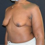 Breast Lift Before & After Patient #889
