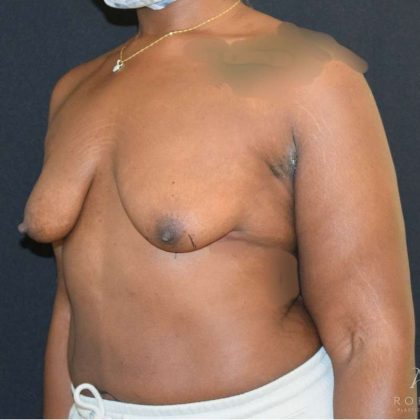 Breast Augmentation Before & After Patient #938
