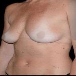 Breast Augmentation Before & After Patient #980