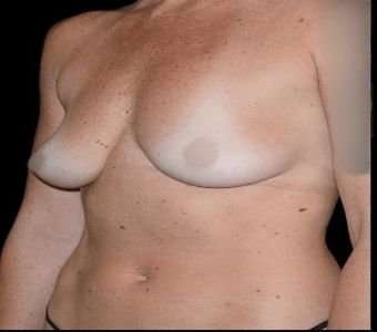 Breast Augmentation Before & After Patient #980