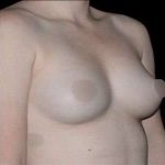 Breast Augmentation Before & After Patient #985
