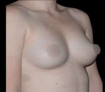 Breast Augmentation Before & After Patient #985