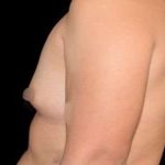 Breast Augmentation Before & After Patient #992