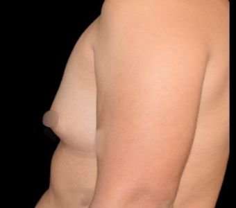 Breast Augmentation Before & After Patient #992