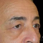 Blepharoplasty Before & After Patient #1000