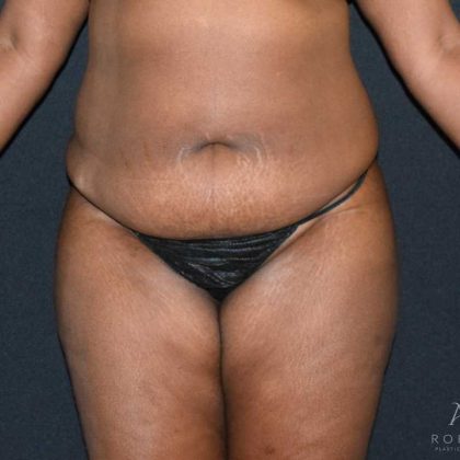 Tummy Tuck Before & After Patient #737