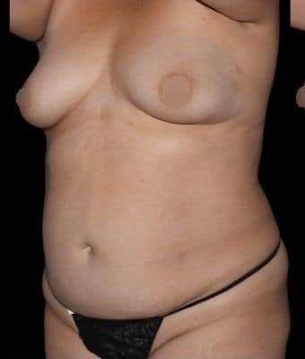 Tummy Tuck Before & After Patient #744