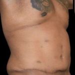 Tummy Tuck Before & After Patient #749