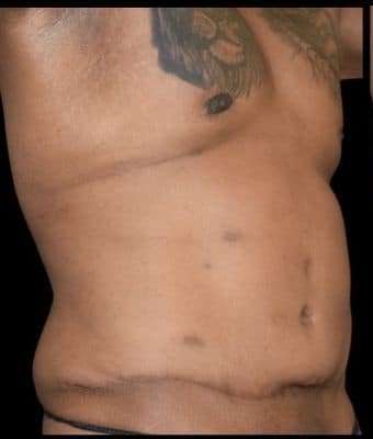 Tummy Tuck Before & After Patient #749