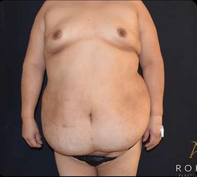Mommy Makeover Before & After Patient #383