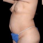 Tummy Tuck Before & After Patient #763
