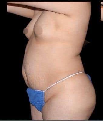 Tummy Tuck Before & After Patient #763