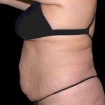 Tummy Tuck Before & After Patient #770