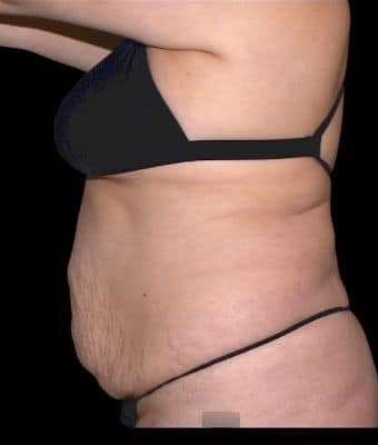 Tummy Tuck Before & After Patient #770