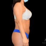 Brazilian Butt Lift Before & After Patient #805
