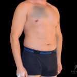 Liposuction Before & After Patient #833